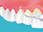 parodontie dentaire agen